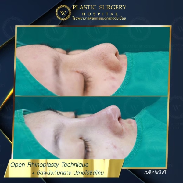 เสริมจมูก