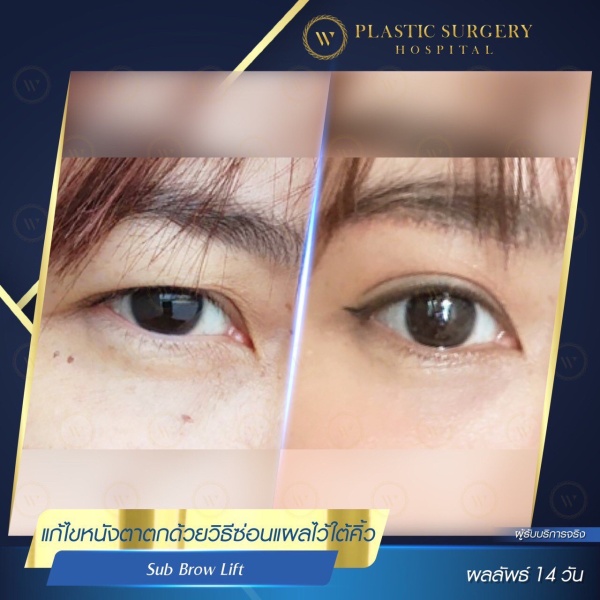 หนังตา/หางตาบนตก