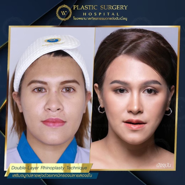 เสริมจมูก