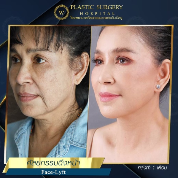 ดึงหน้า