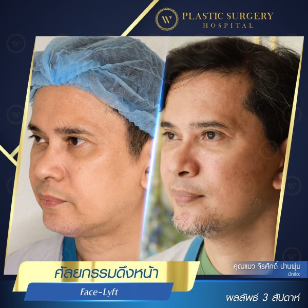 ดึงหน้า