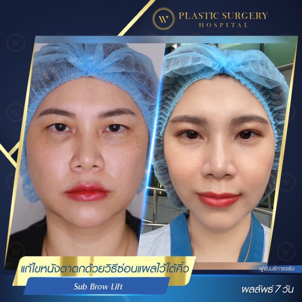 หนังตา/หางตาบนตก