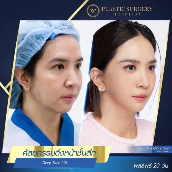 ดึงหน้า