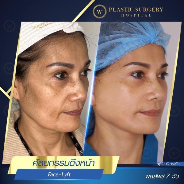 ดึงหน้า