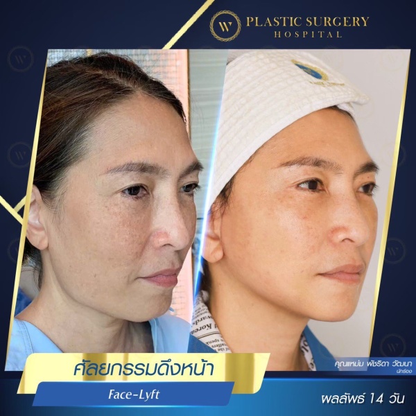 ดึงหน้า