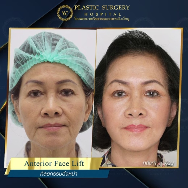 ดึงหน้า