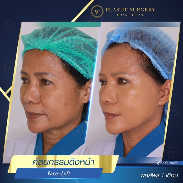 ดึงหน้า