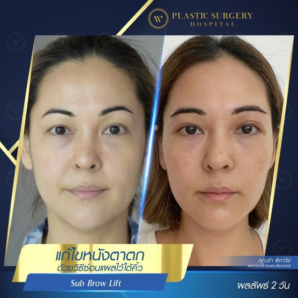 หนังตา/หางตาบนตก