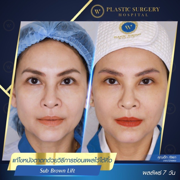 หนังตา/หางตาบนตก