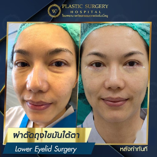 ตัดถุงไขมันใต้ตา