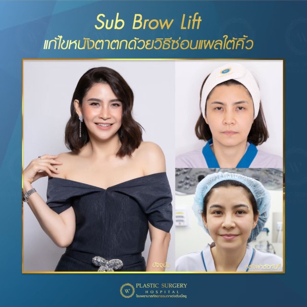 หนังตา/หางตาบนตก