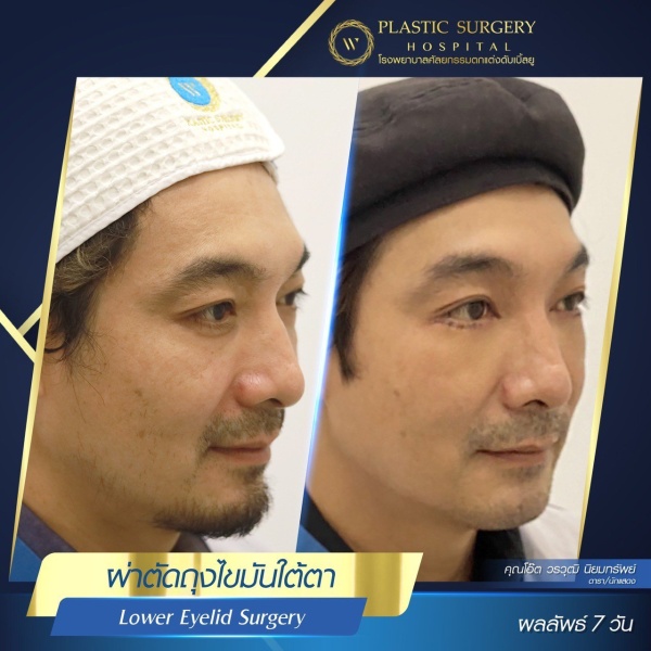 ตัดถุงไขมันใต้ตา