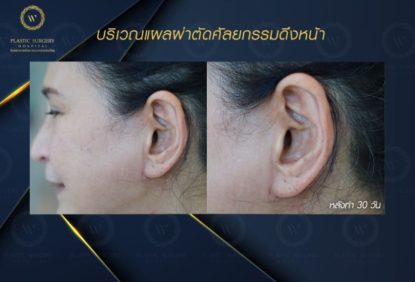 ดึงหน้า