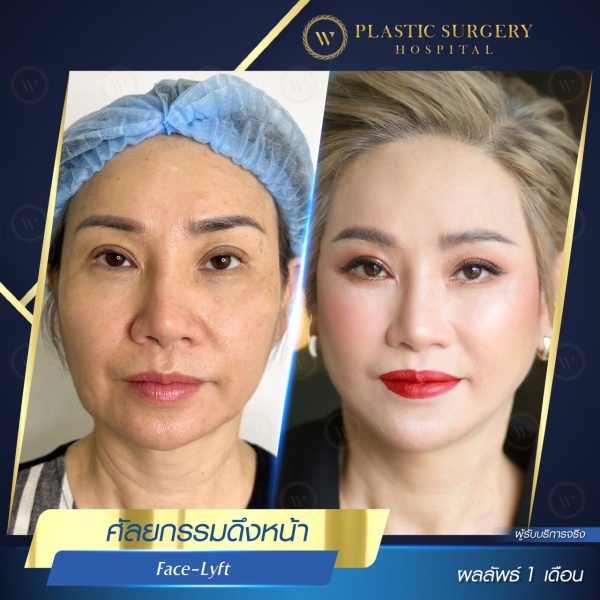 ดึงหน้า