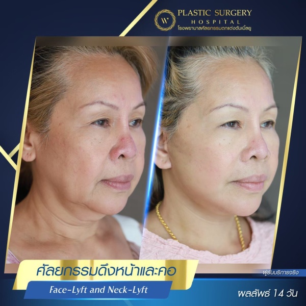 ดึงหน้า