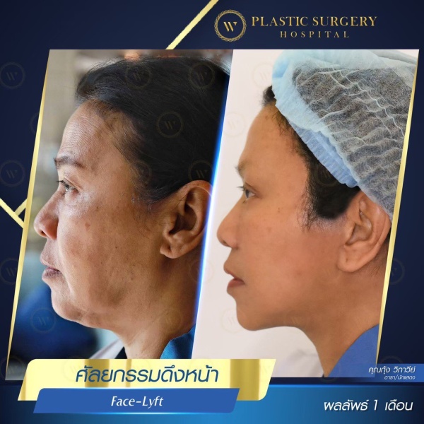 ดึงหน้า