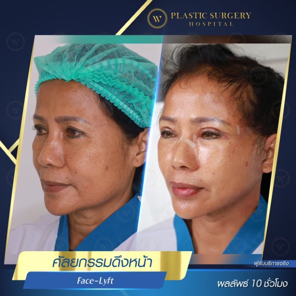 ดึงหน้า