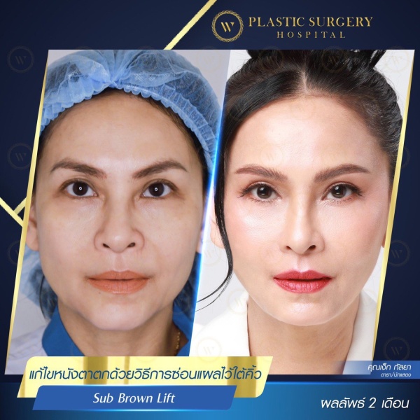 หนังตา/หางตาบนตก