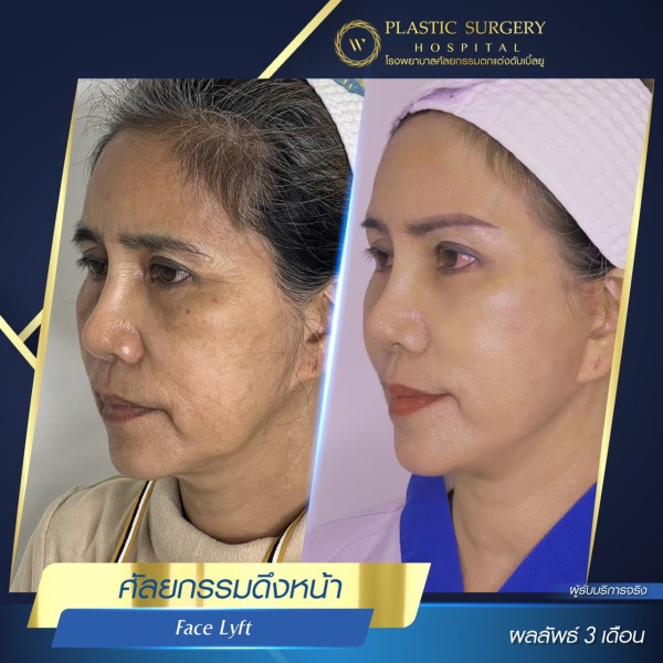 ดึงหน้า