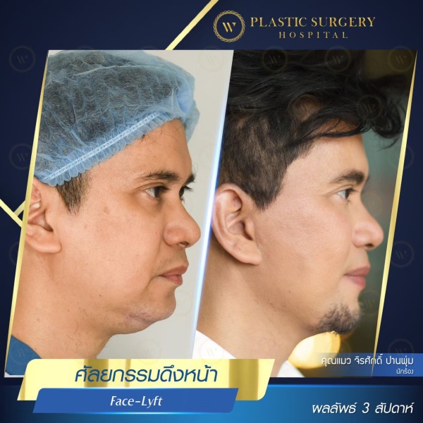 ดึงหน้า