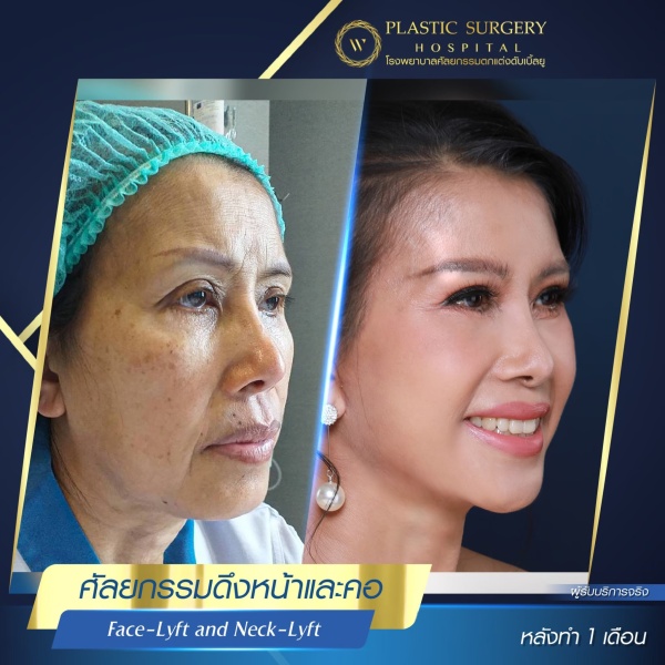 ดึงหน้า