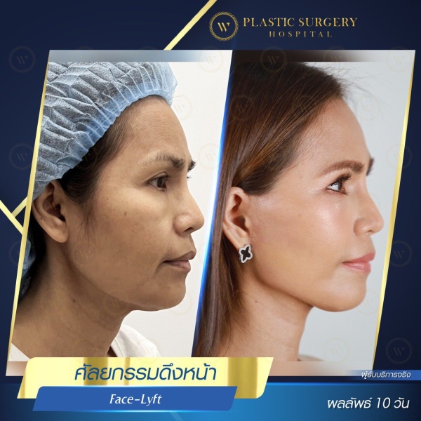 ดึงหน้า