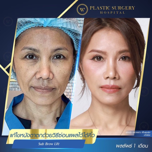 หนังตา/หางตาบนตก