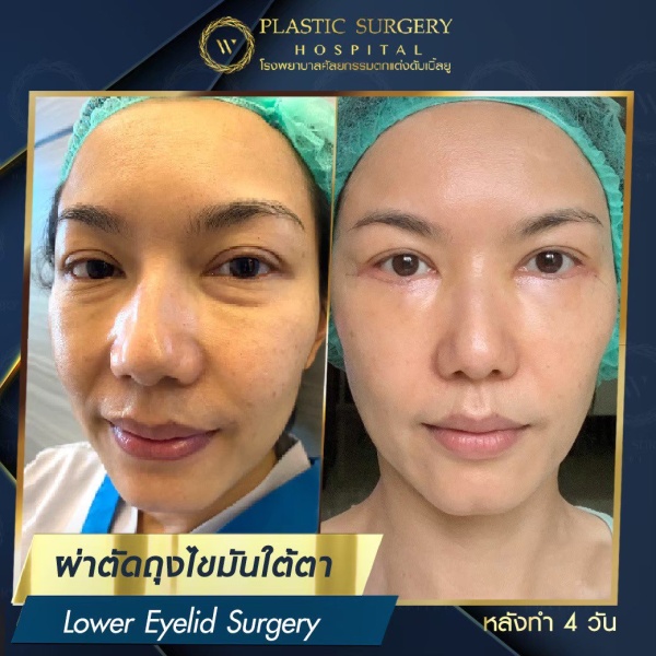 ตัดถุงไขมันใต้ตา
