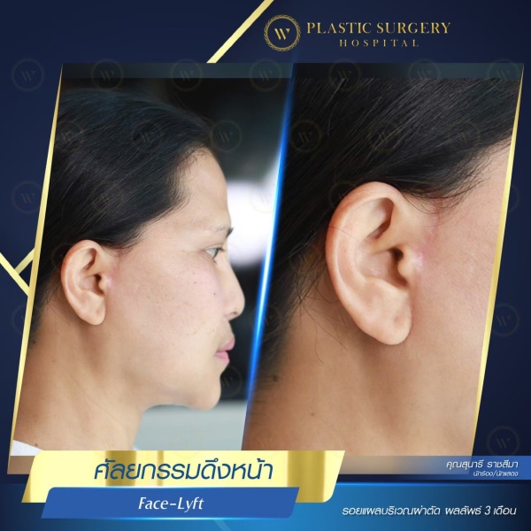 ดึงหน้า