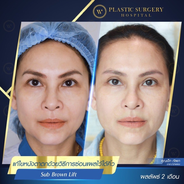 หนังตา/หางตาบนตก