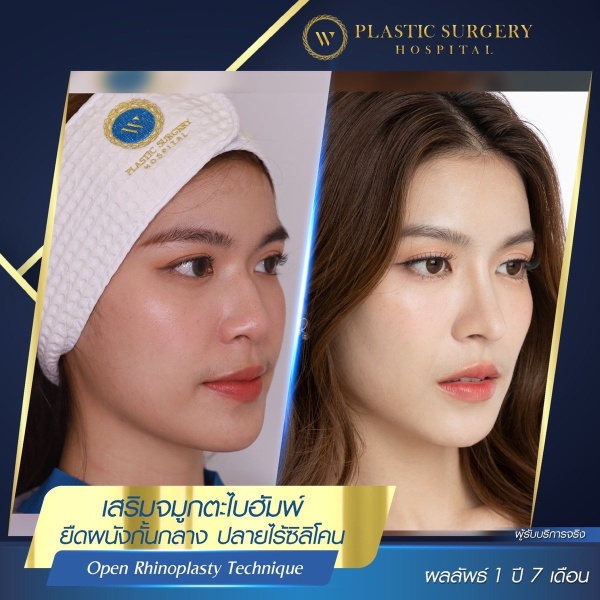 เสริมจมูก