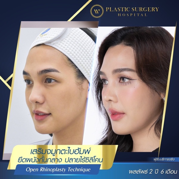 เสริมจมูก