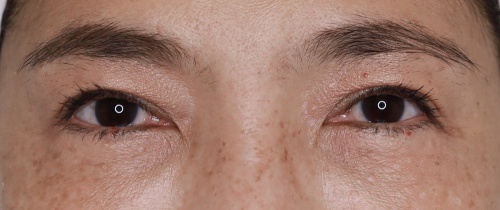 หนังตา/หางตาบนตก