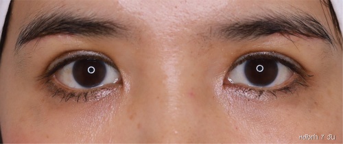 หนังตา/หางตาบนตก