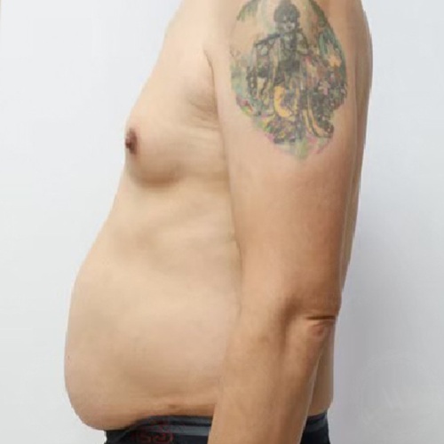 ดูดไขมัน