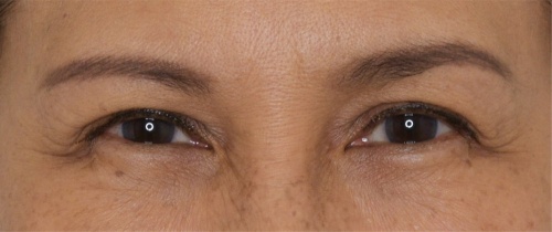 หนังตา/หางตาบนตก