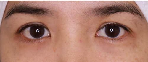 หนังตา/หางตาบนตก