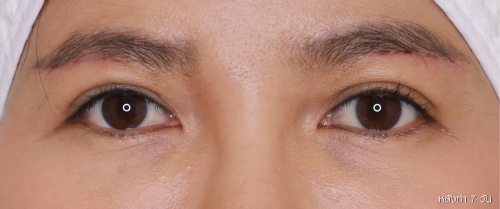 หนังตา/หางตาบนตก