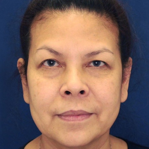 ดึงหน้า