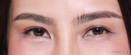 หนังตา/หางตาบนตก