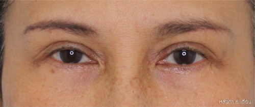 หนังตา/หางตาบนตก