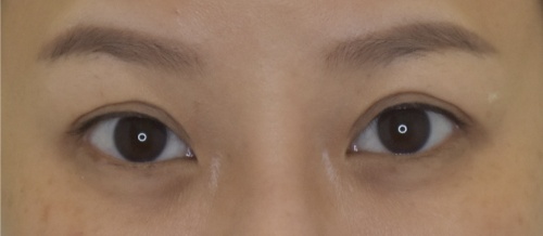 หนังตา/หางตาบนตก