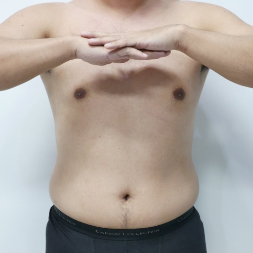 ดูดไขมัน