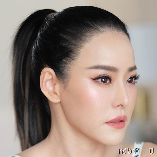 ดูดไขมันเหนียงใต้คาง (FaceTite)