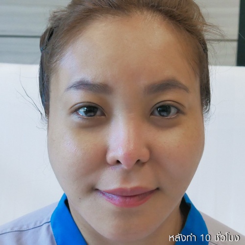 ดึงหน้า