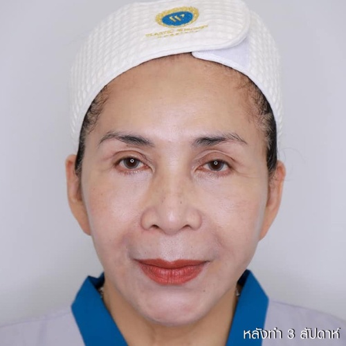 ดึงหน้า