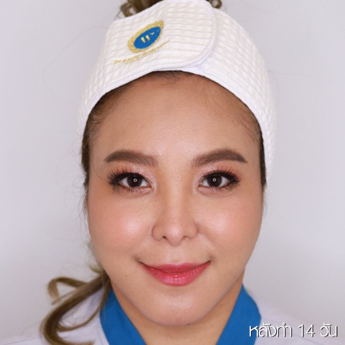 ดูดไขมันเหนียงใต้คาง (FaceTite)