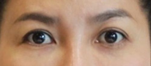 หนังตา/หางตาบนตก