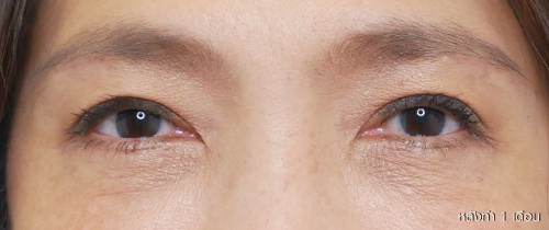 หนังตา/หางตาบนตก