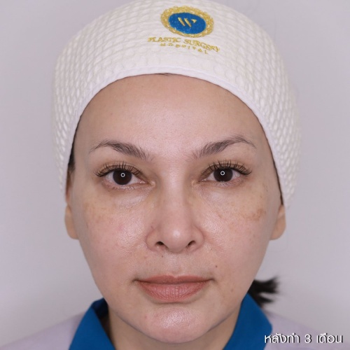 ดึงหน้า